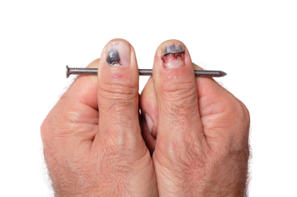 Dập móng tay - Hình ảnh minh họa